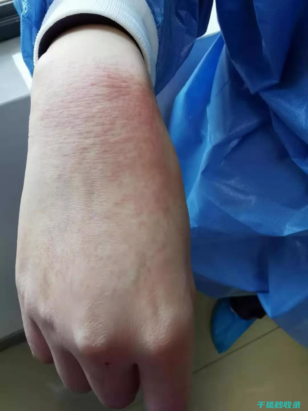 干裂手部的救星？这些护手霜你真的该试试！ (干裂手部的救治措施)